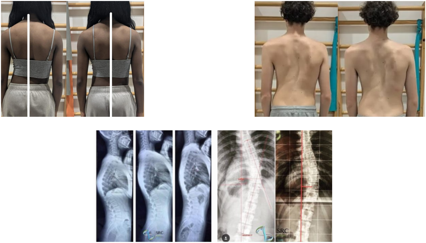 Photographies comparatives de dos et radiographies de scoliose présentées côte à côte